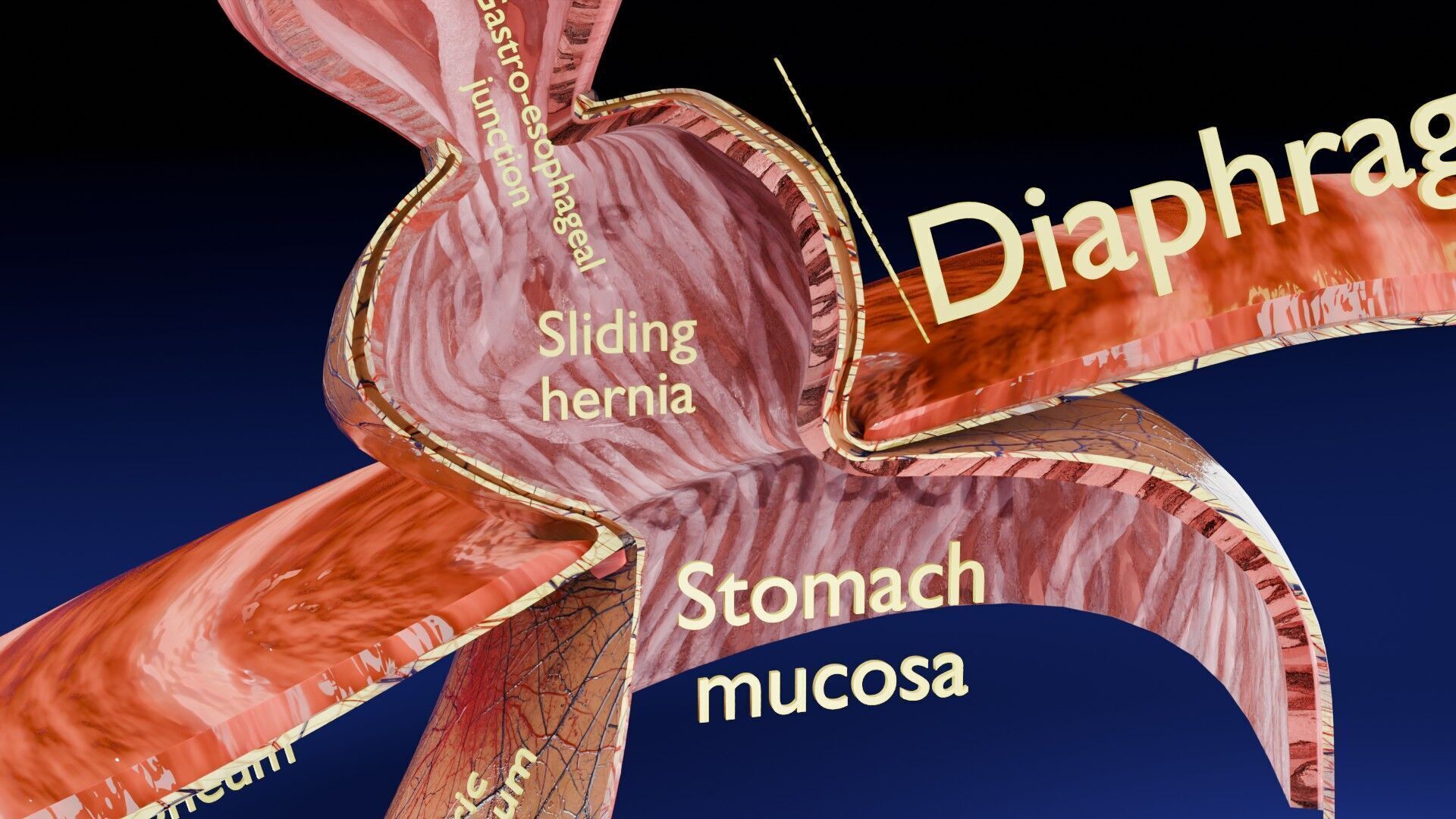 Hiatal hernia stomach sliding paraesophageal Low-poly 3D model_21