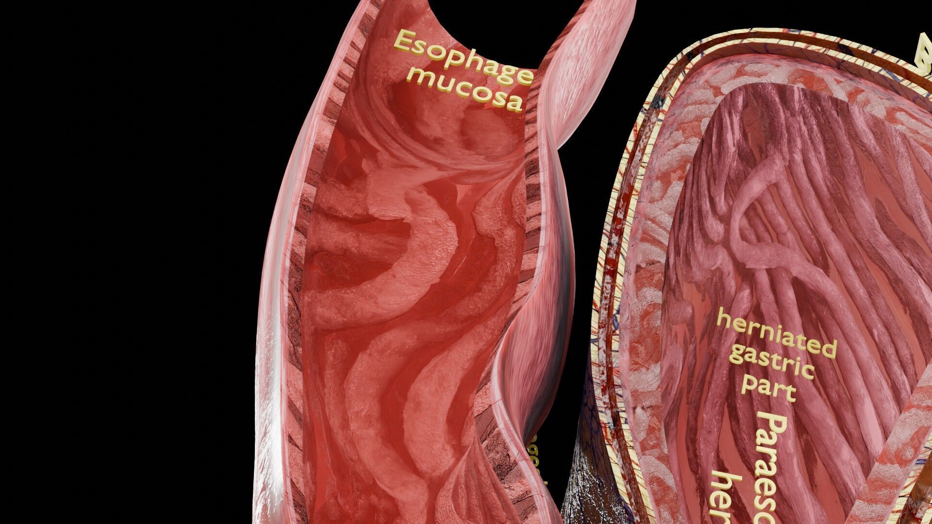 Hiatal hernia stomach sliding paraesophageal Low-poly 3D model_11