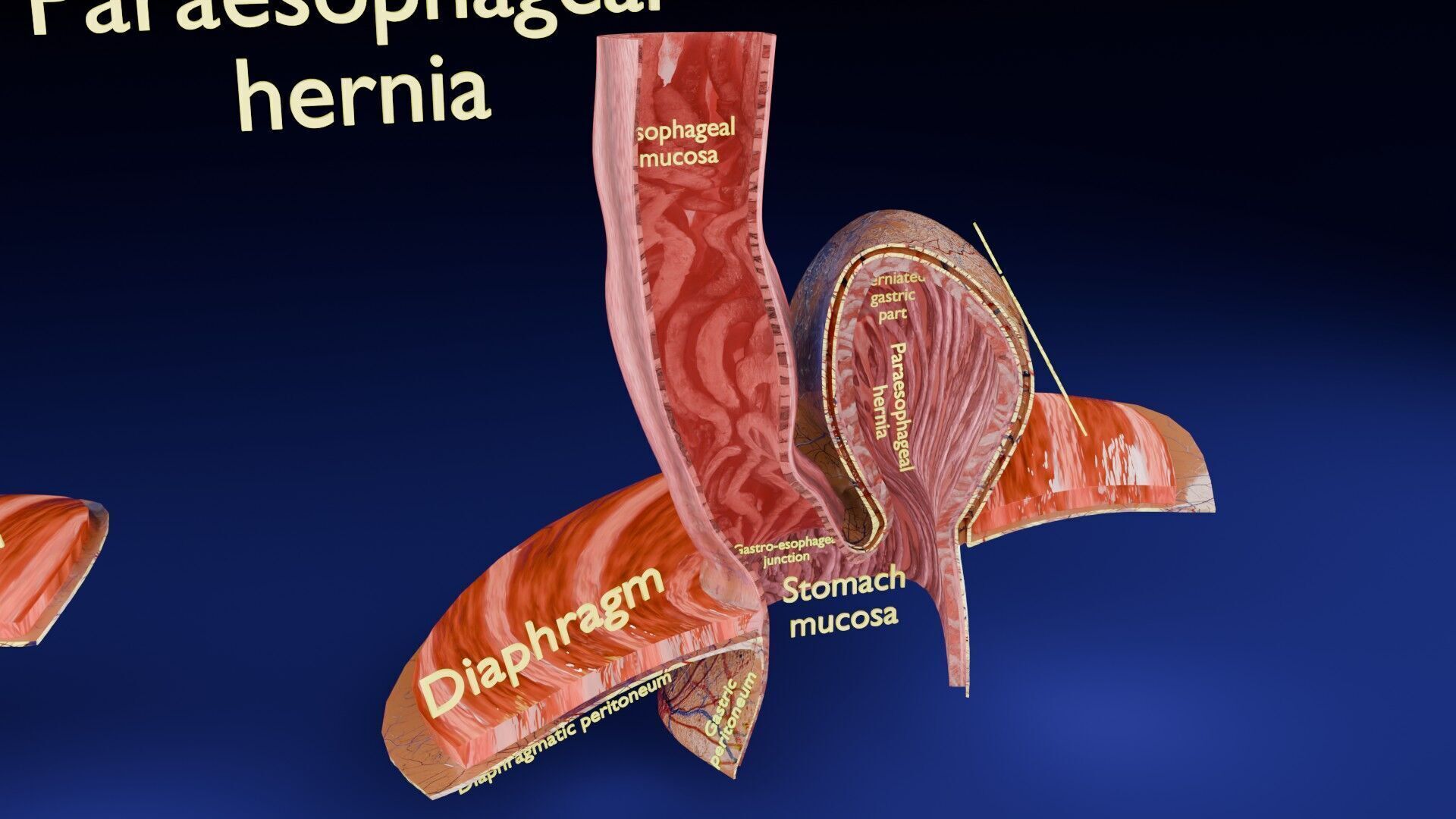 Hiatal hernia stomach sliding paraesophageal Low-poly 3D model_5