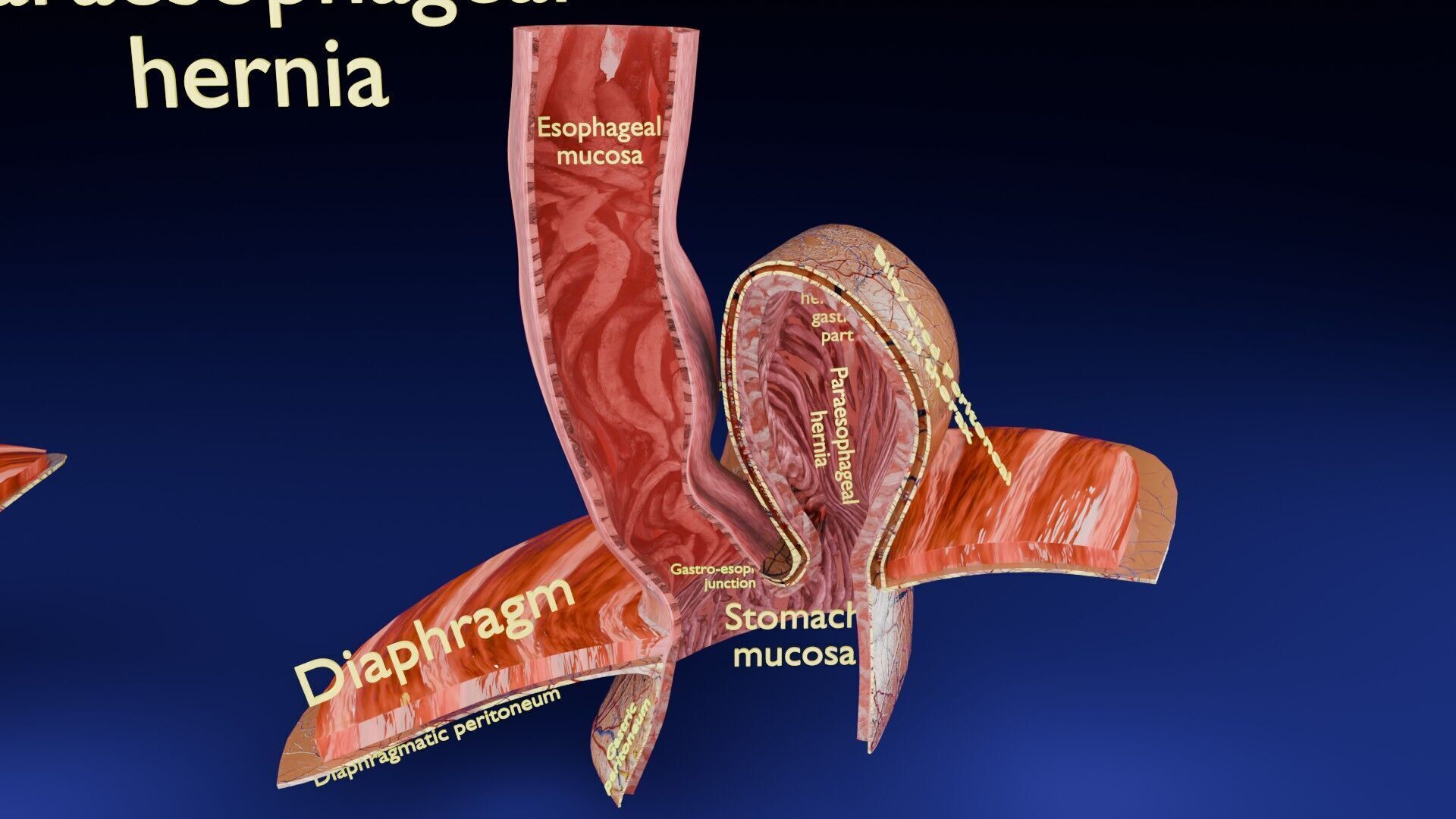 Hiatal hernia stomach sliding paraesophageal Low-poly 3D model_4