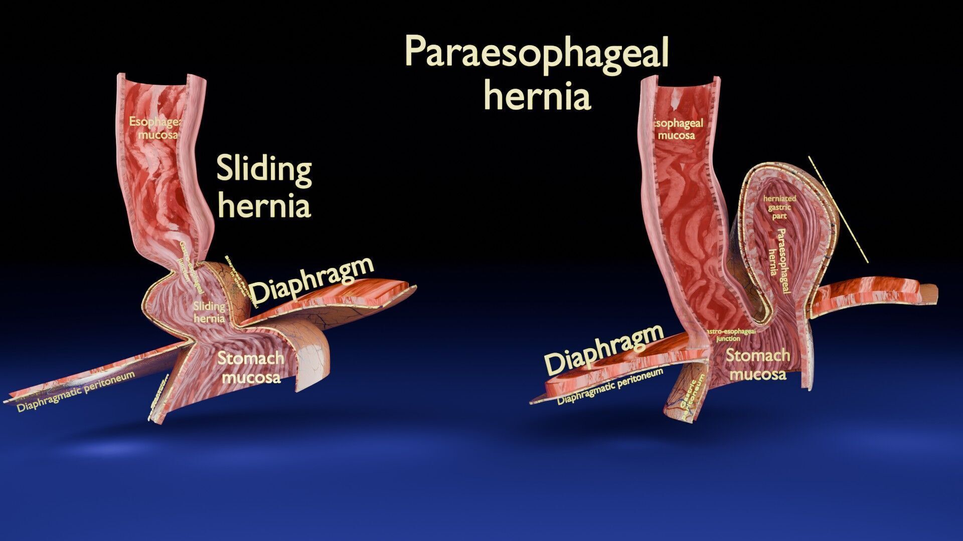Hiatal hernia stomach sliding paraesophageal Low-poly 3D model_1