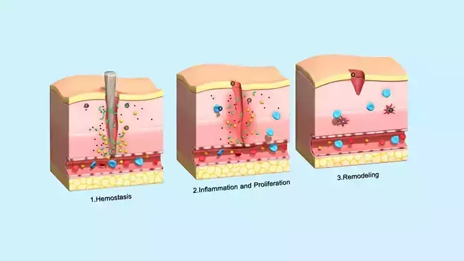 Skin Wound Healing Low-poly 3D model