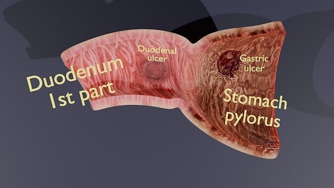 Peptic Ulcer Stomach duodenum  Low-poly 3D model
