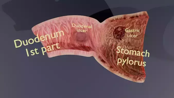 Peptic Ulcer Stomach duodenum  Low-poly 3D model