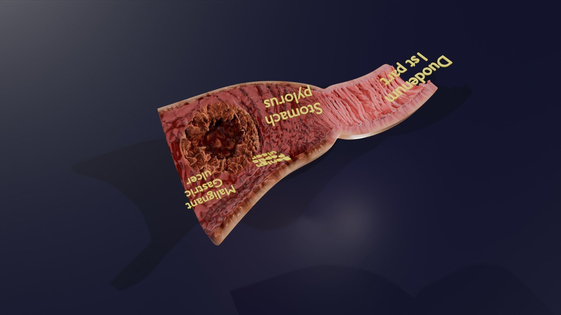 Gastric Ulcer Benign versus Malignant Low-poly 3D model_28