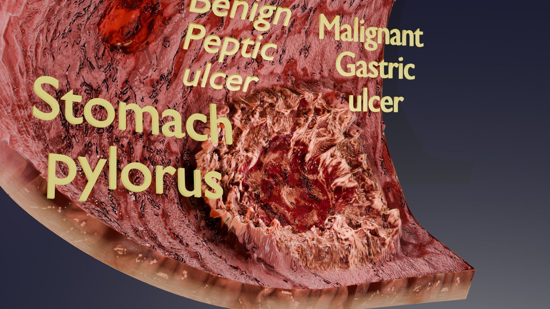 Gastric Ulcer Benign versus Malignant Low-poly 3D model_8