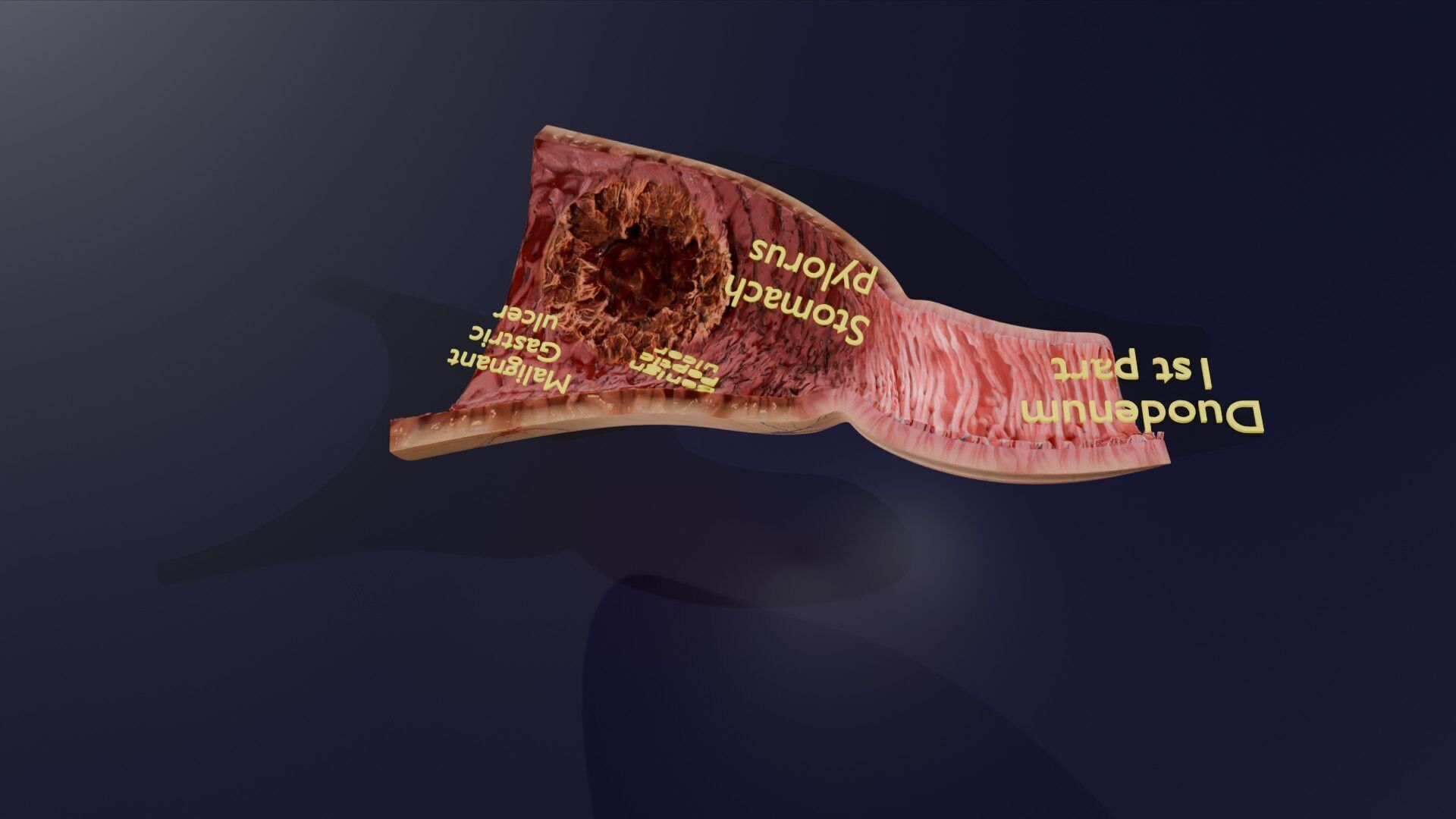 Gastric Ulcer Benign versus Malignant Low-poly 3D model_39