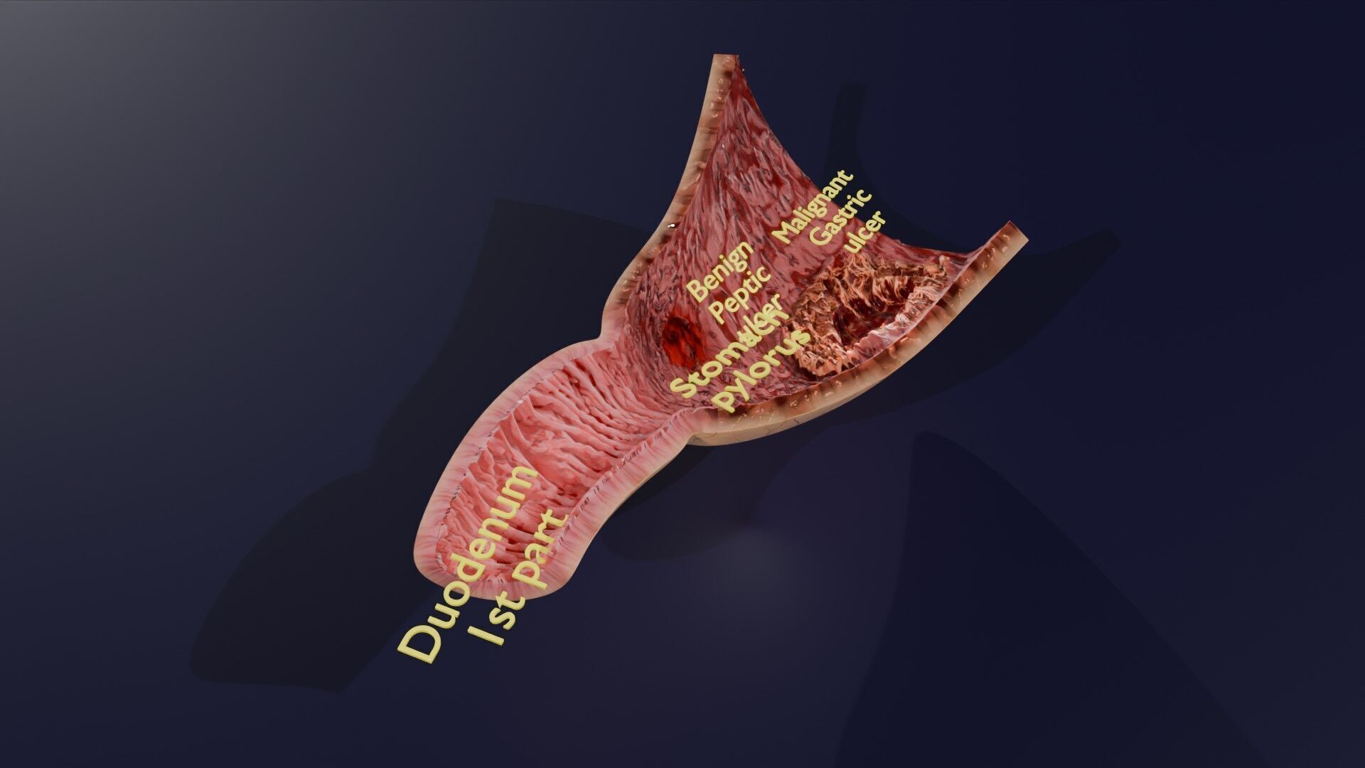 Gastric Ulcer Benign versus Malignant Low-poly 3D model_25