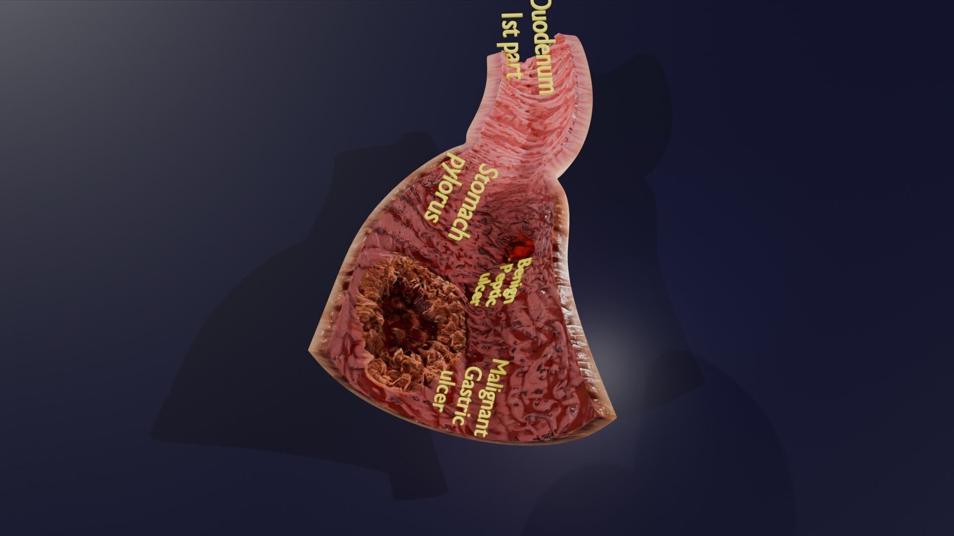 Gastric Ulcer Benign versus Malignant Low-poly 3D model_37
