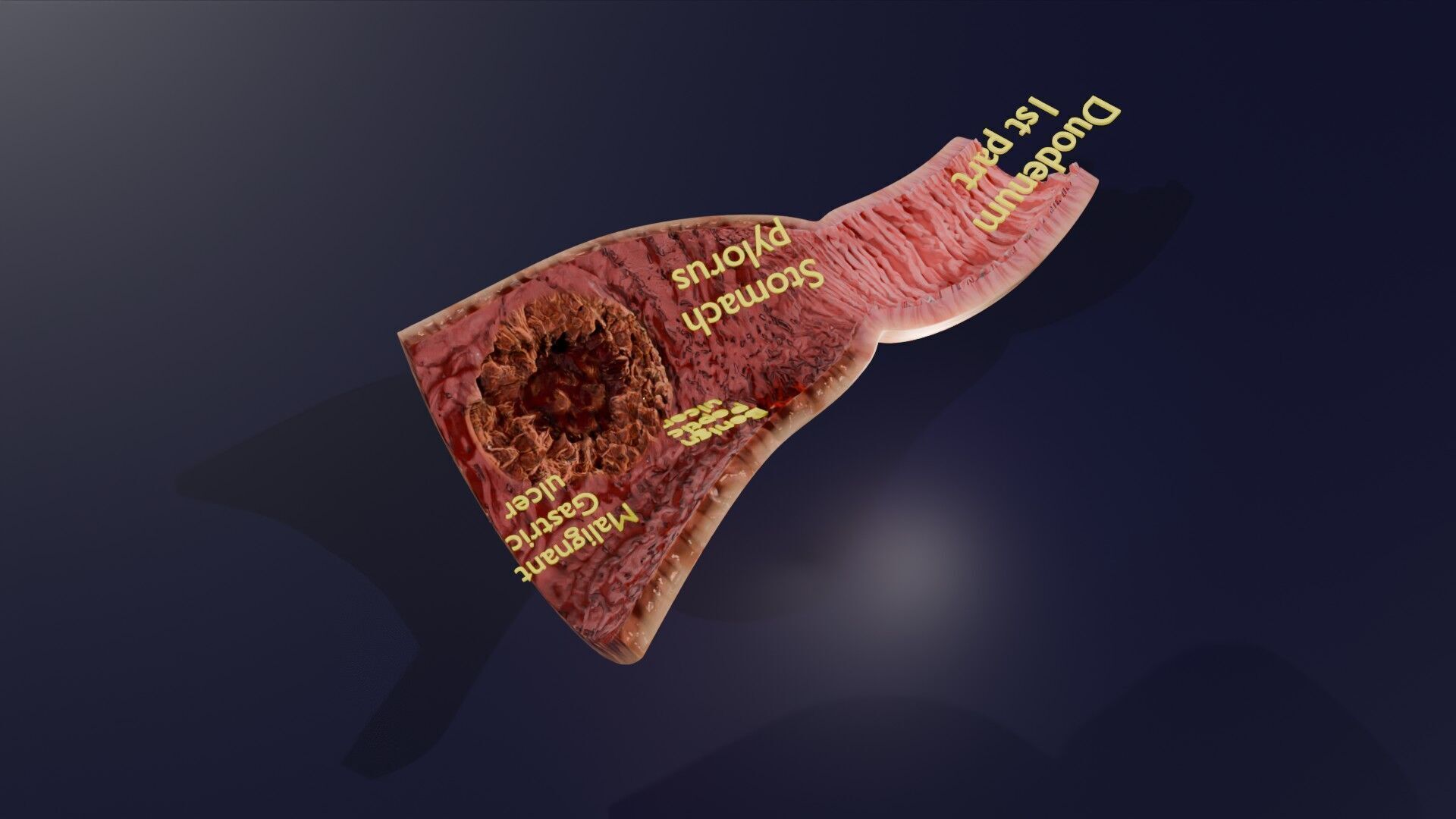 Gastric Ulcer Benign versus Malignant Low-poly 3D model_45