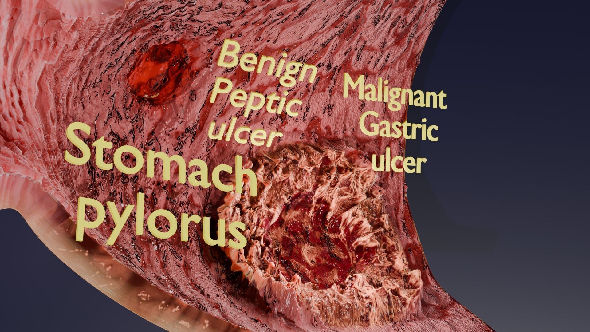 Gastric Ulcer Benign versus Malignant Low-poly 3D model_9