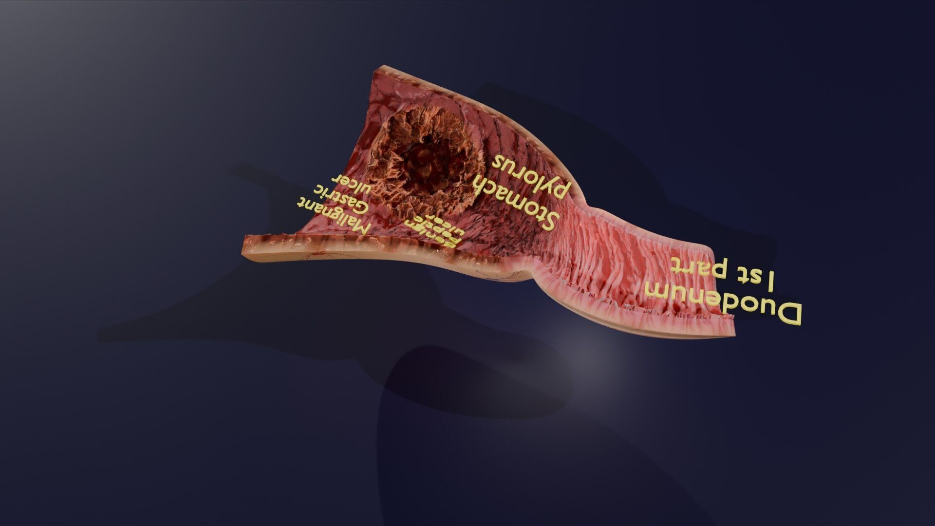 Gastric Ulcer Benign versus Malignant Low-poly 3D model_32