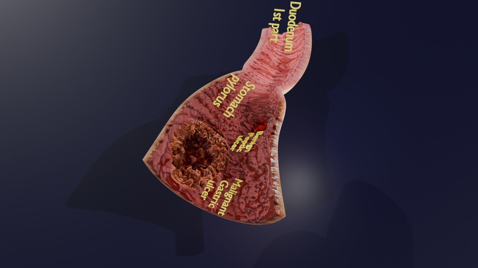 Gastric Ulcer Benign versus Malignant Low-poly 3D model_50
