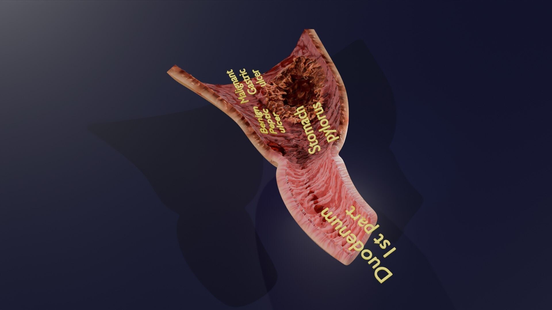 Gastric Ulcer Benign versus Malignant Low-poly 3D model_31