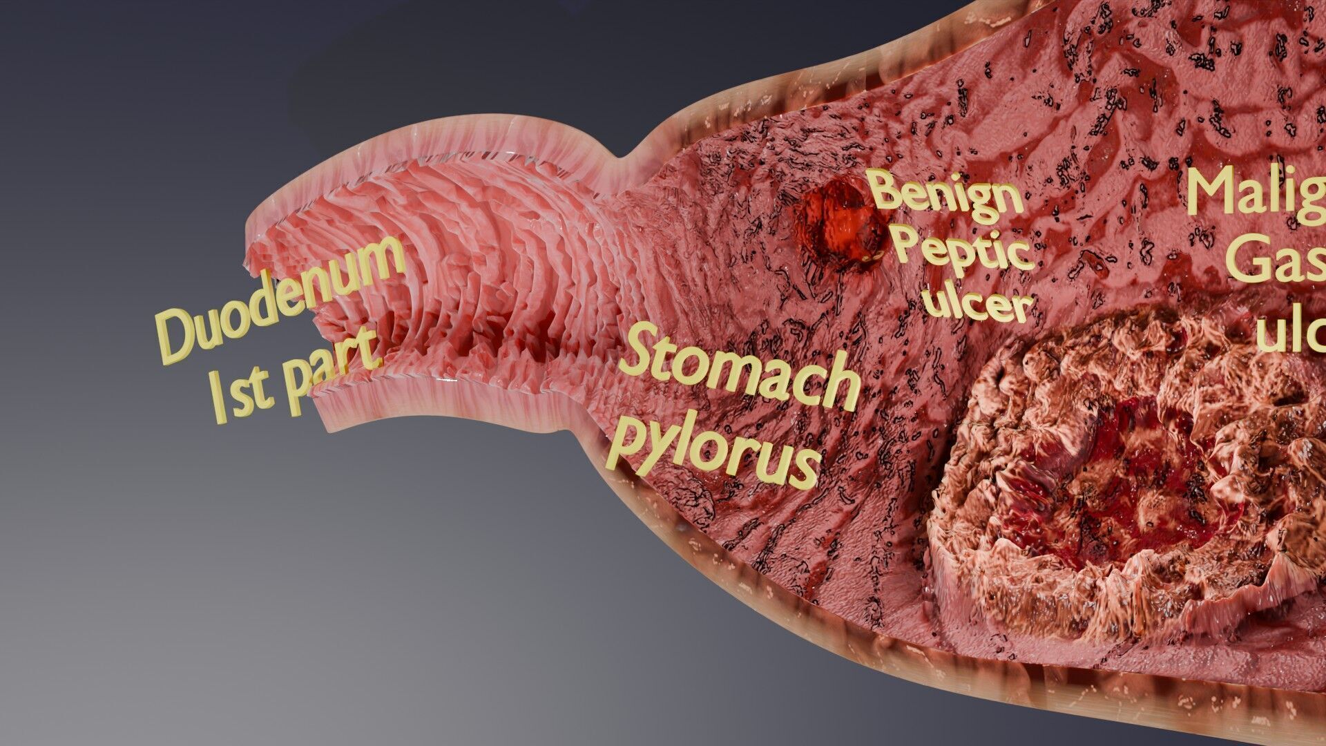 Gastric Ulcer Benign versus Malignant Low-poly 3D model_4