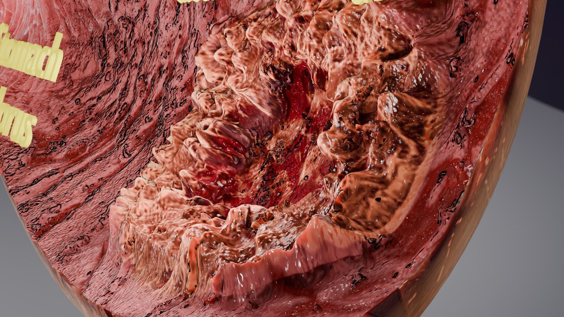 Gastric Ulcer Benign versus Malignant Low-poly 3D model_7