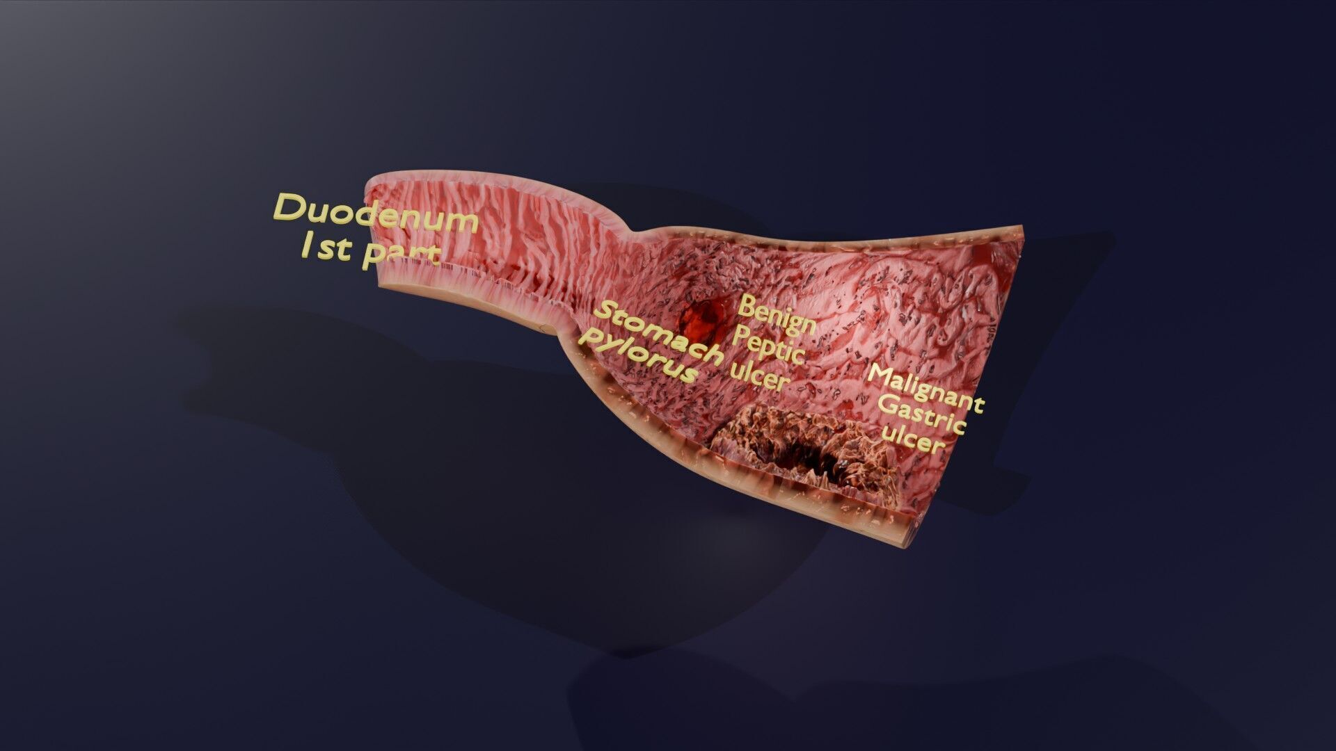 Gastric Ulcer Benign versus Malignant Low-poly 3D model_47