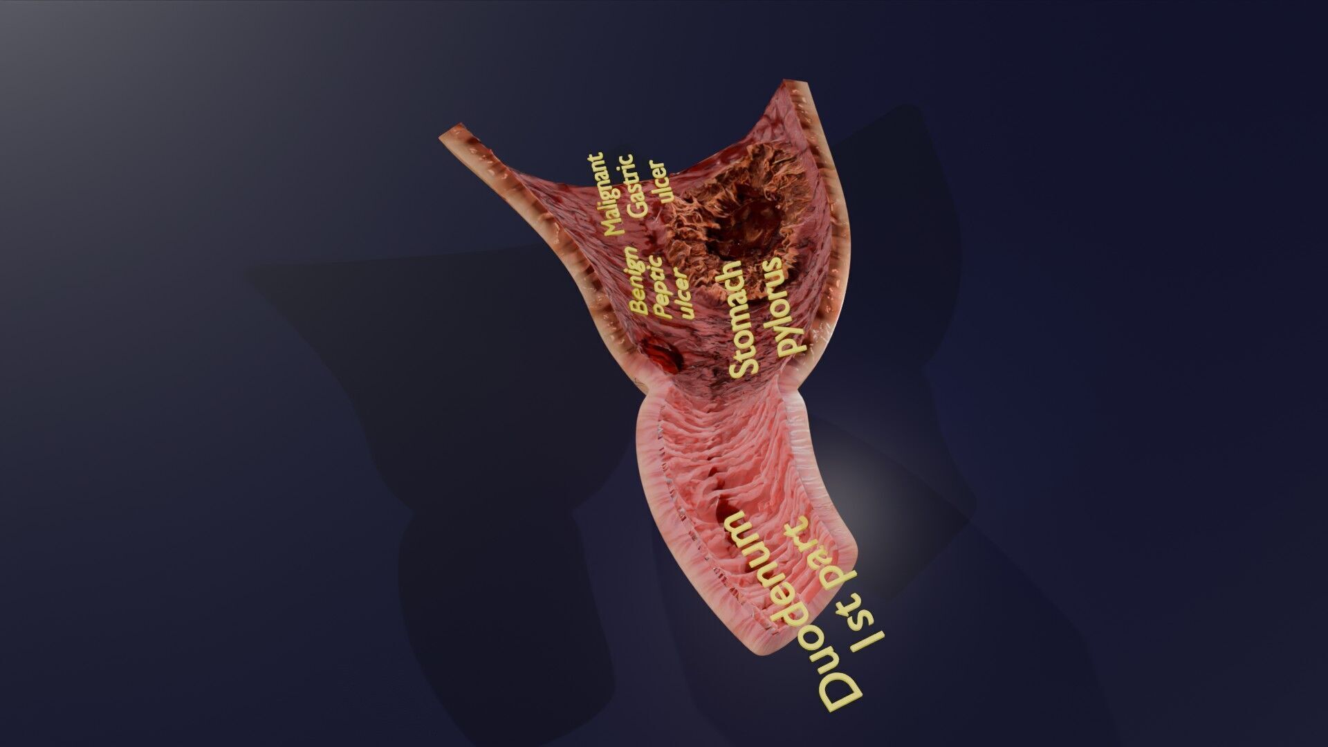 Gastric Ulcer Benign versus Malignant Low-poly 3D model_29