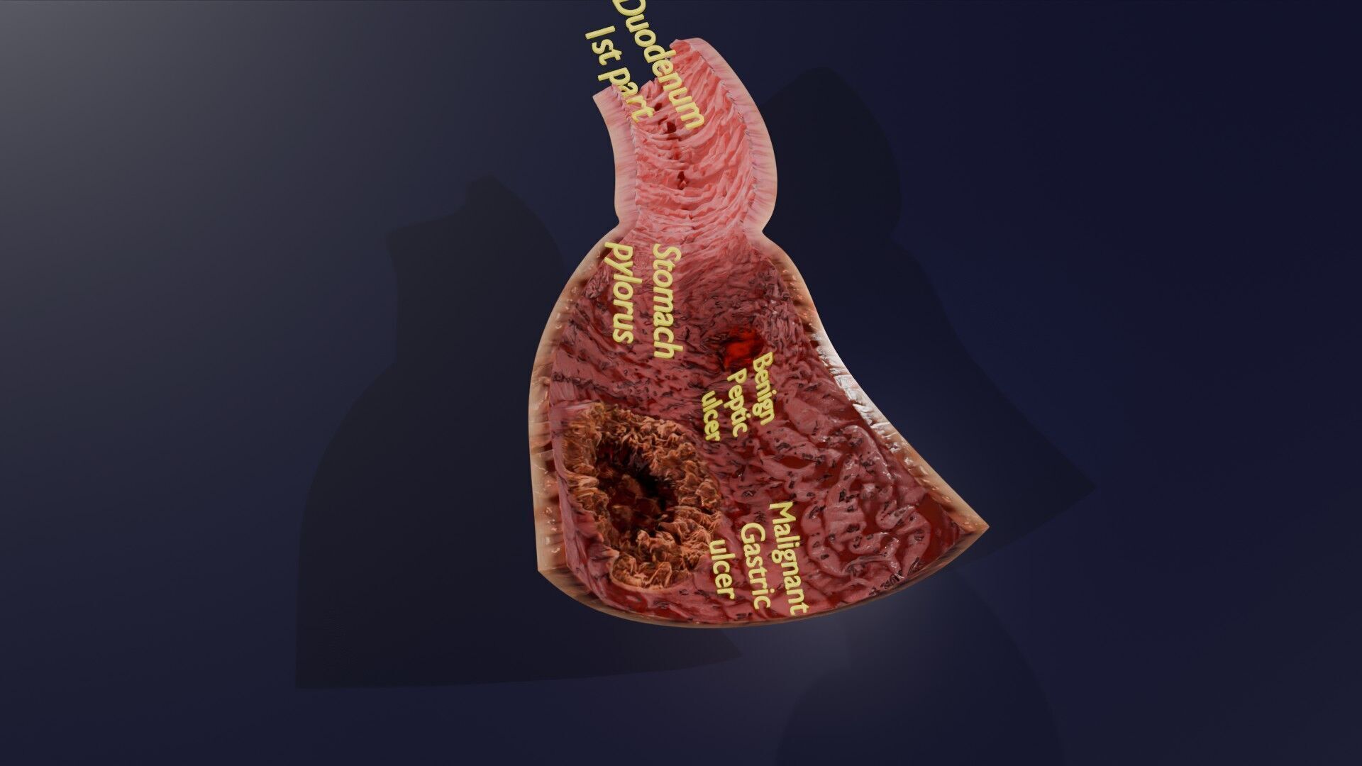 Gastric Ulcer Benign versus Malignant Low-poly 3D model_34
