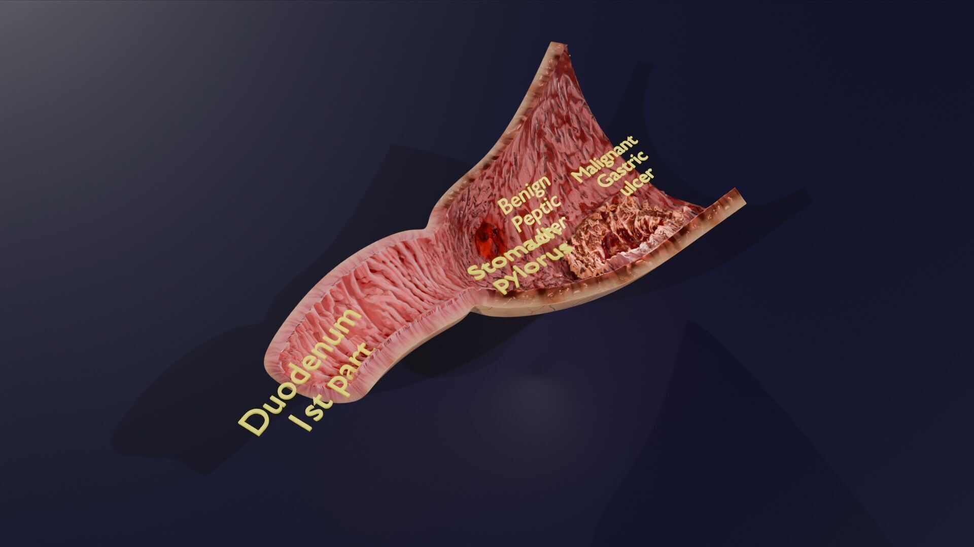 Gastric Ulcer Benign versus Malignant Low-poly 3D model_30