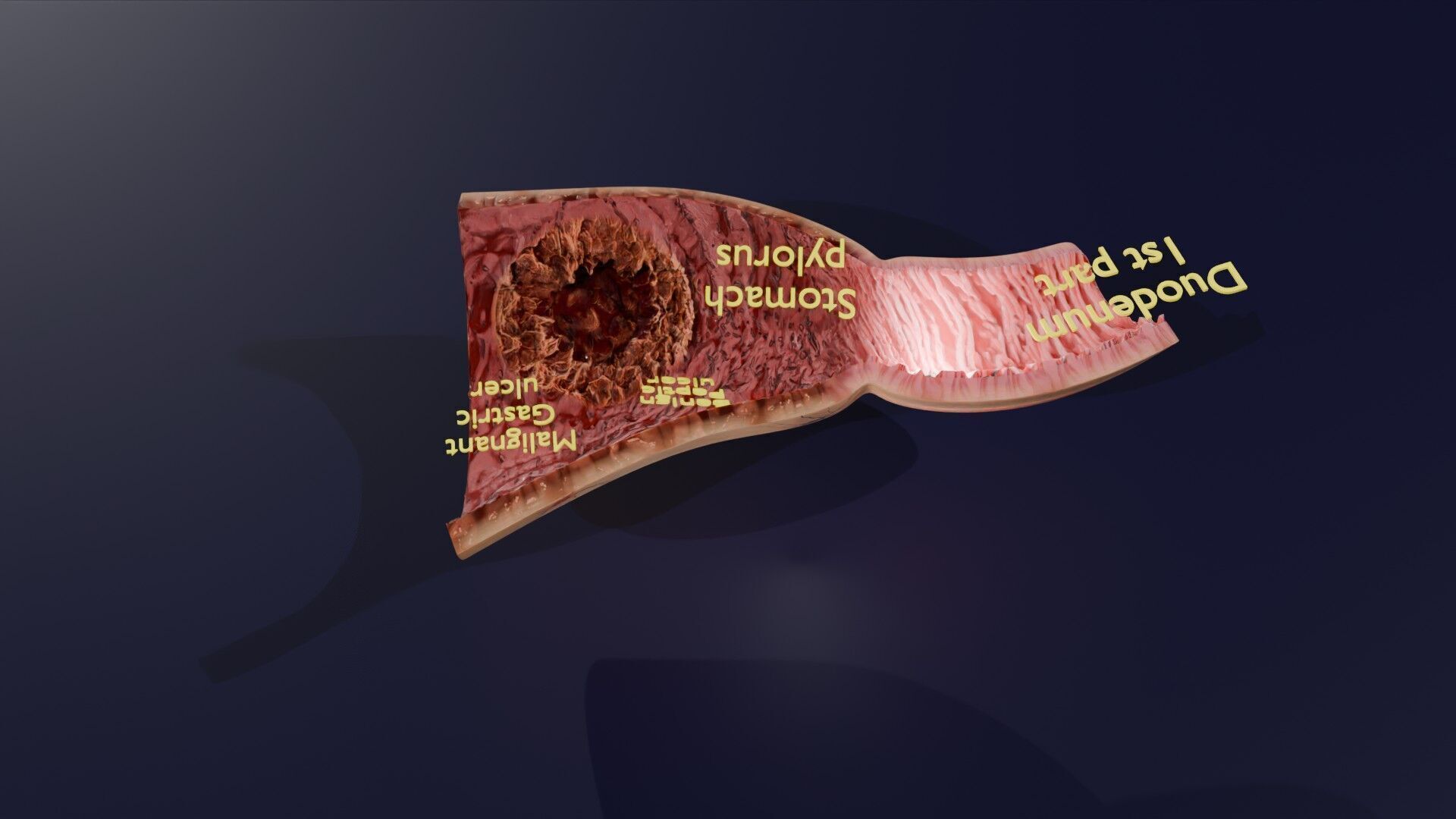 Gastric Ulcer Benign versus Malignant Low-poly 3D model_41