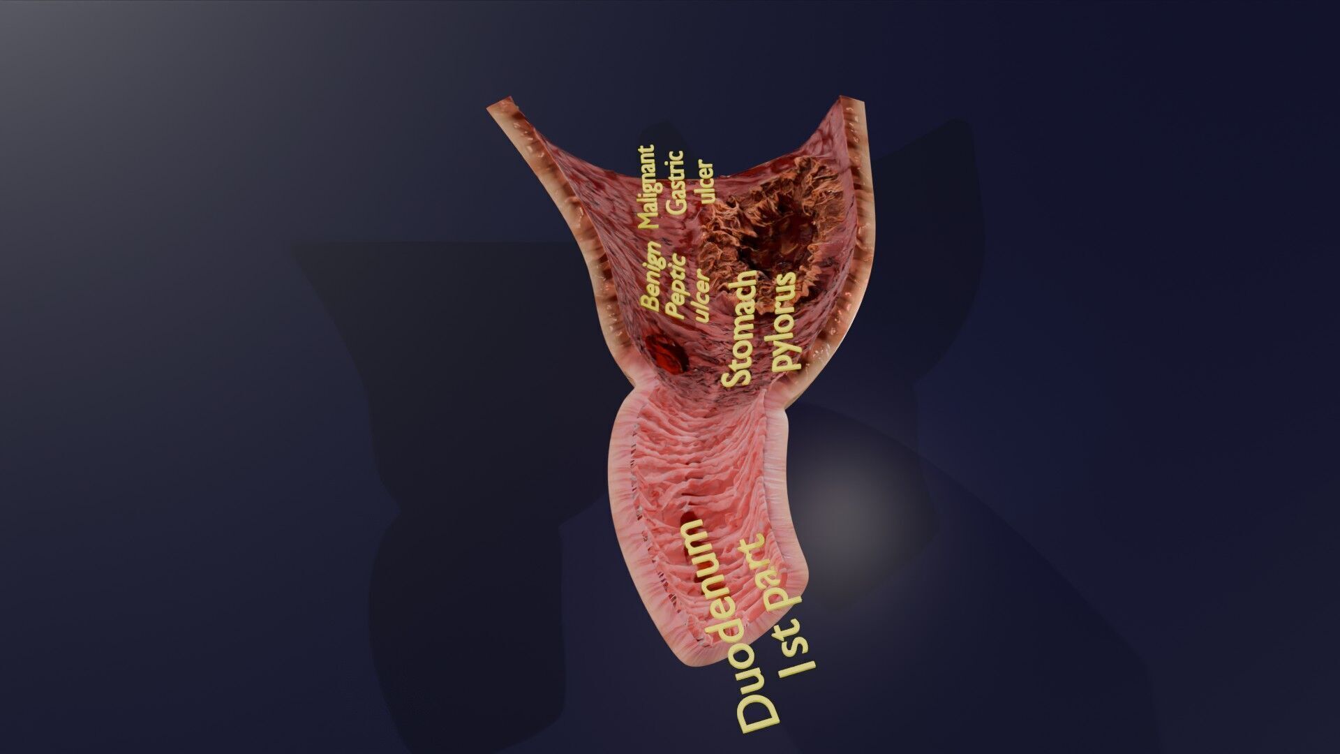 Gastric Ulcer Benign versus Malignant Low-poly 3D model_24