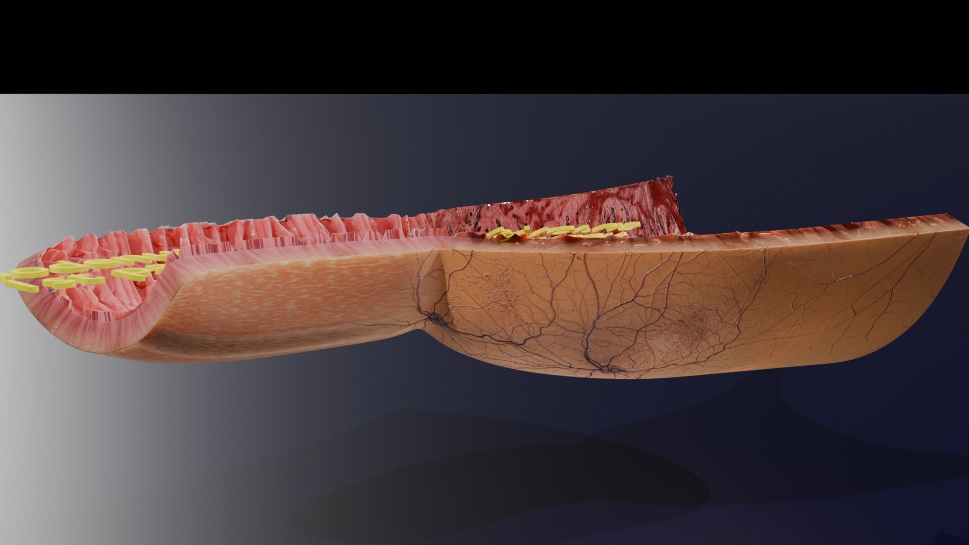 Gastric Ulcer Benign versus Malignant Low-poly 3D model_11