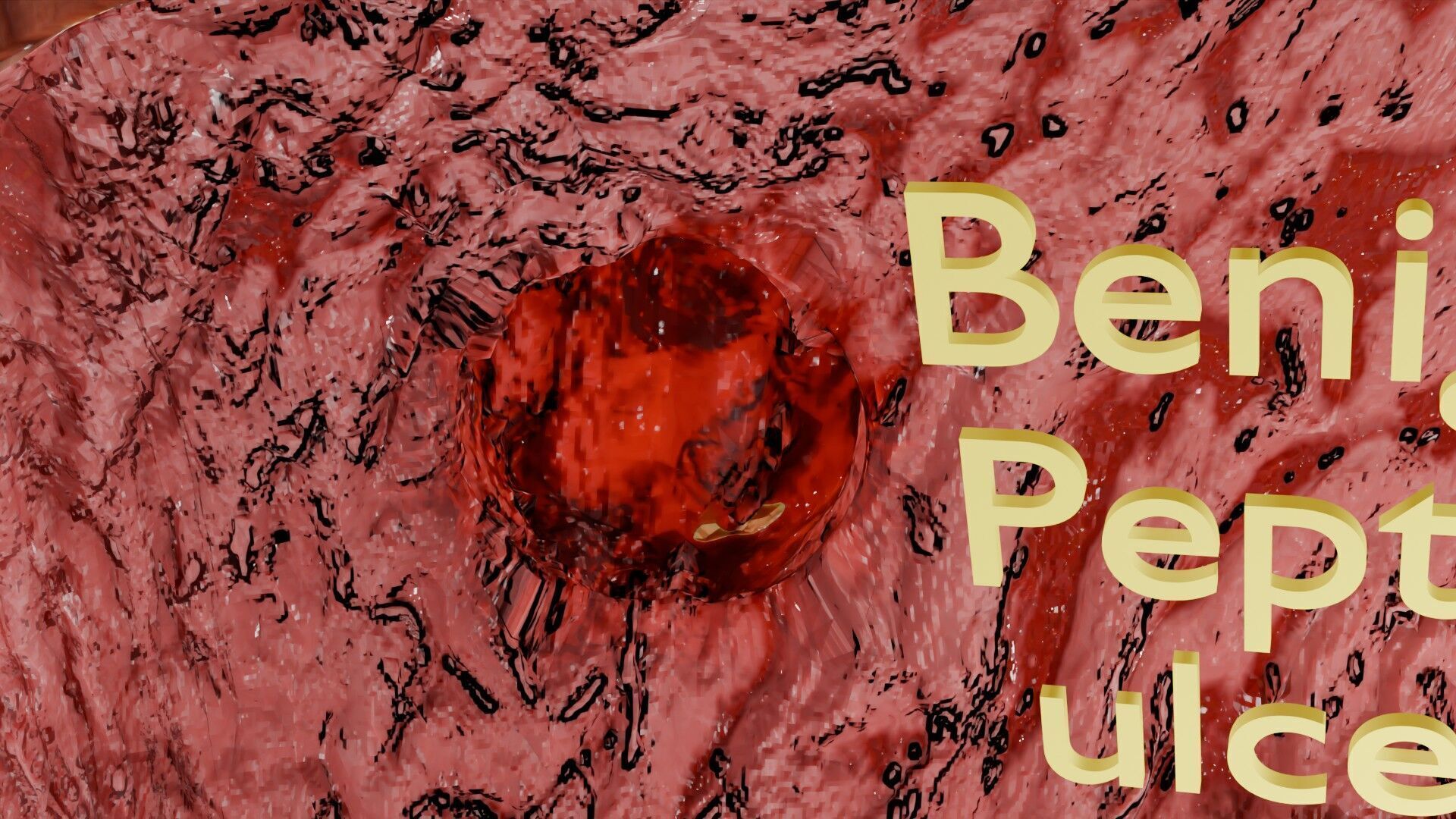 Gastric Ulcer Benign versus Malignant Low-poly 3D model_6