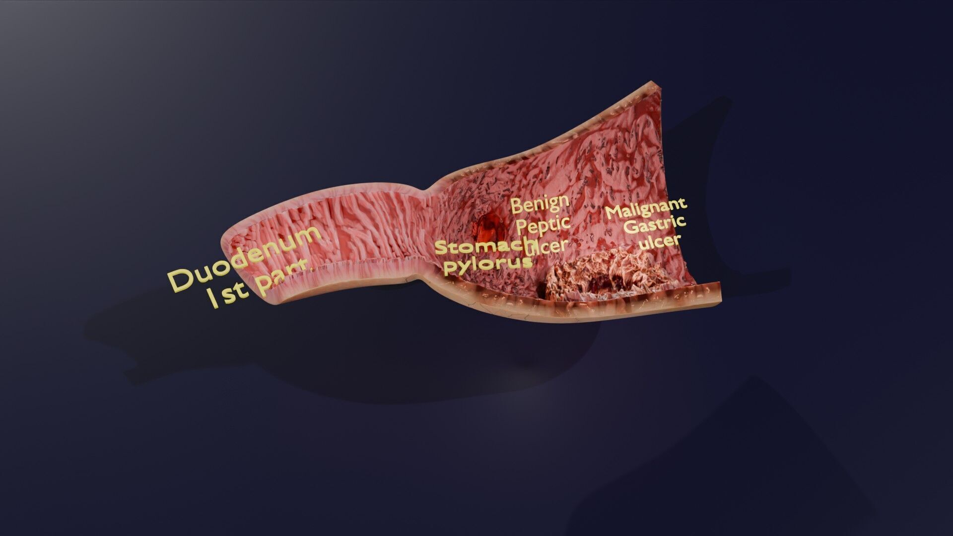 Gastric Ulcer Benign versus Malignant Low-poly 3D model_46