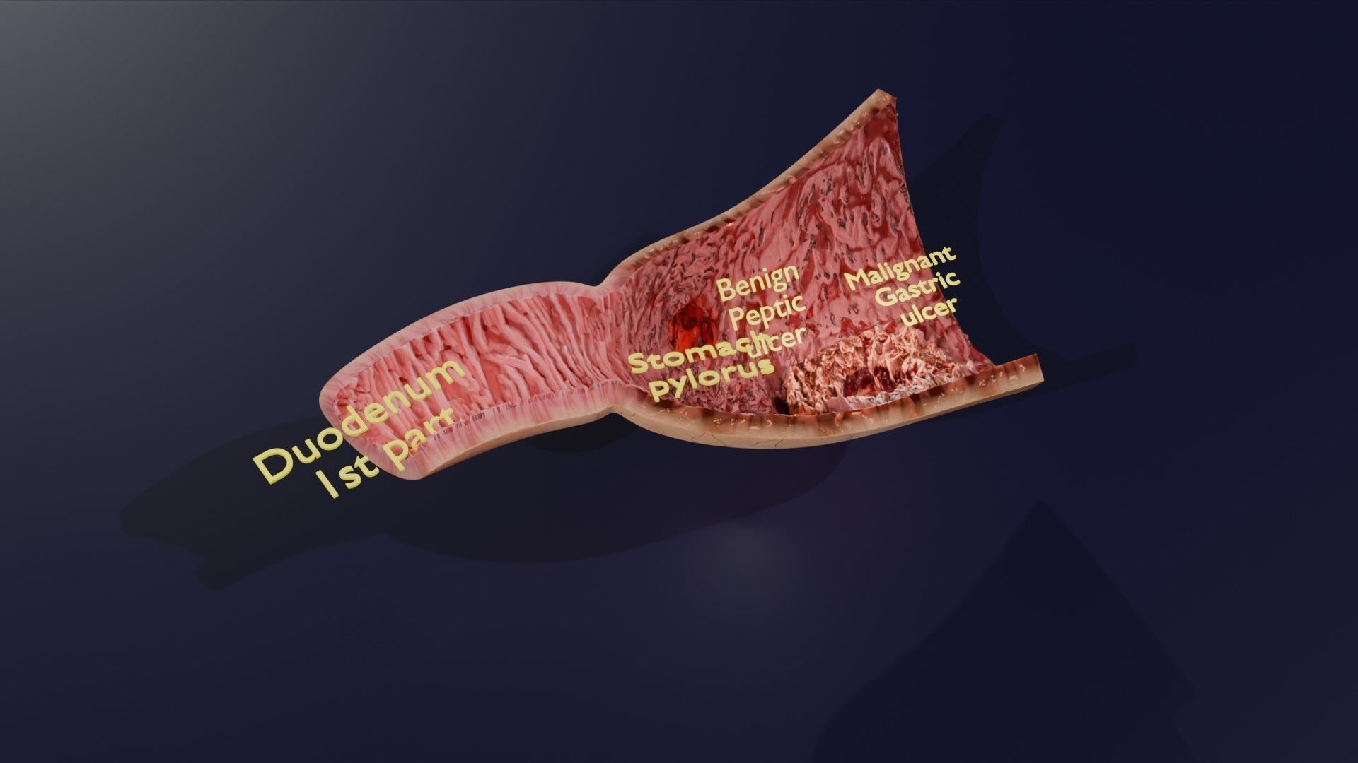 Gastric Ulcer Benign versus Malignant Low-poly 3D model_52