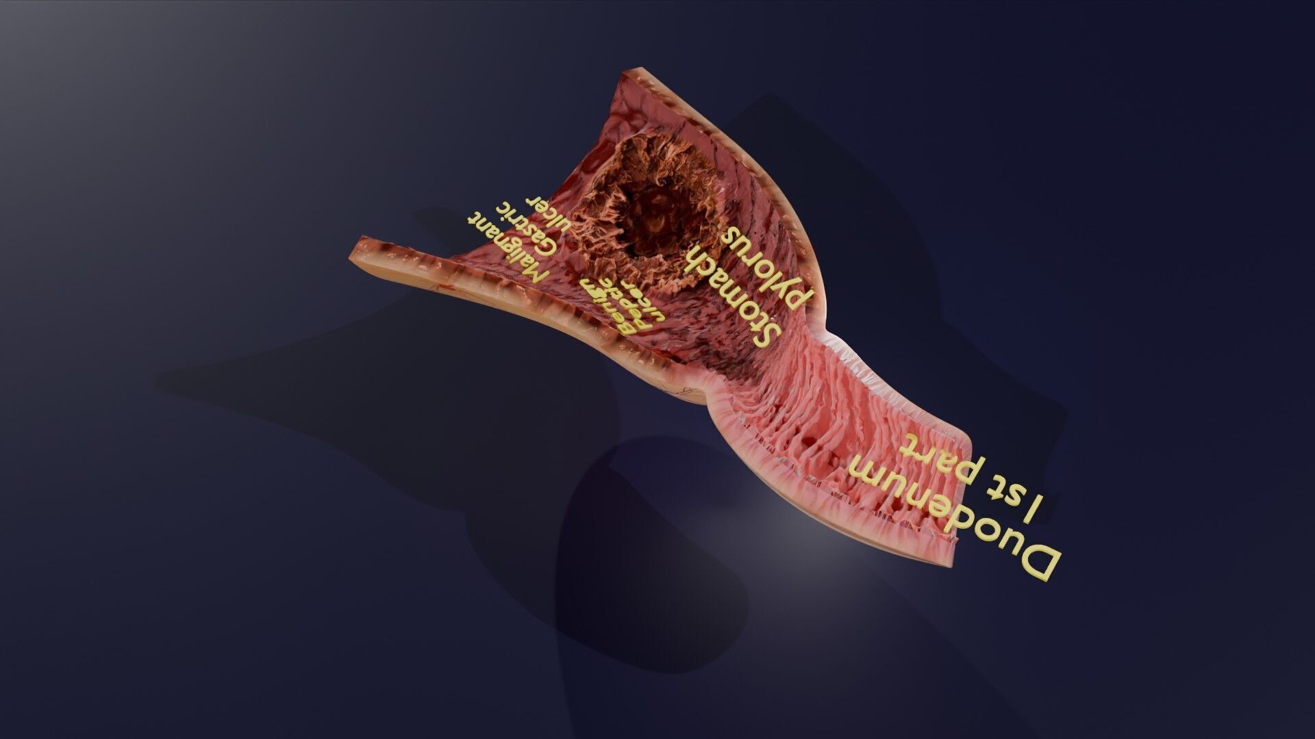 Gastric Ulcer Benign versus Malignant Low-poly 3D model_55