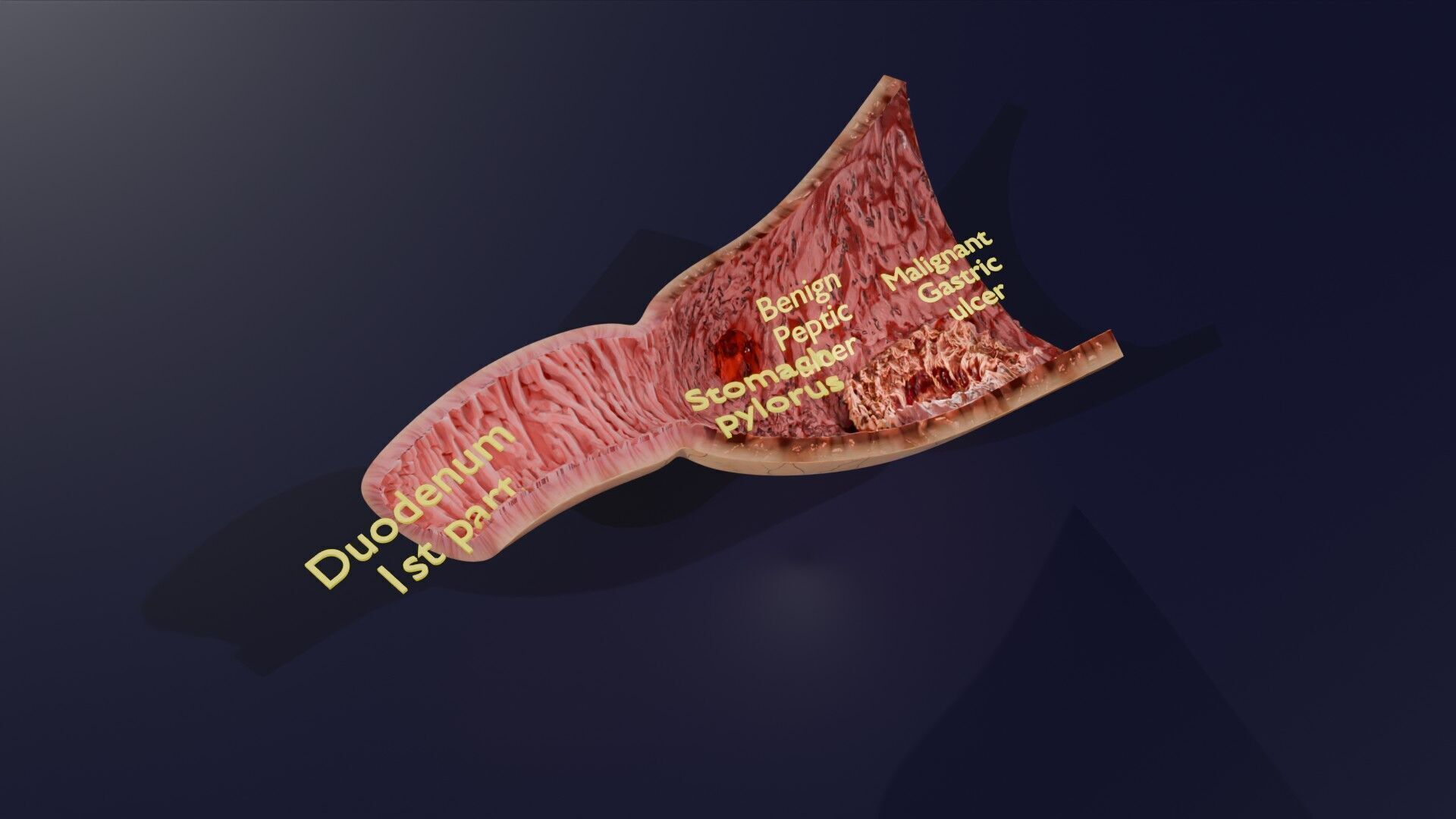 Gastric Ulcer Benign versus Malignant Low-poly 3D model_56