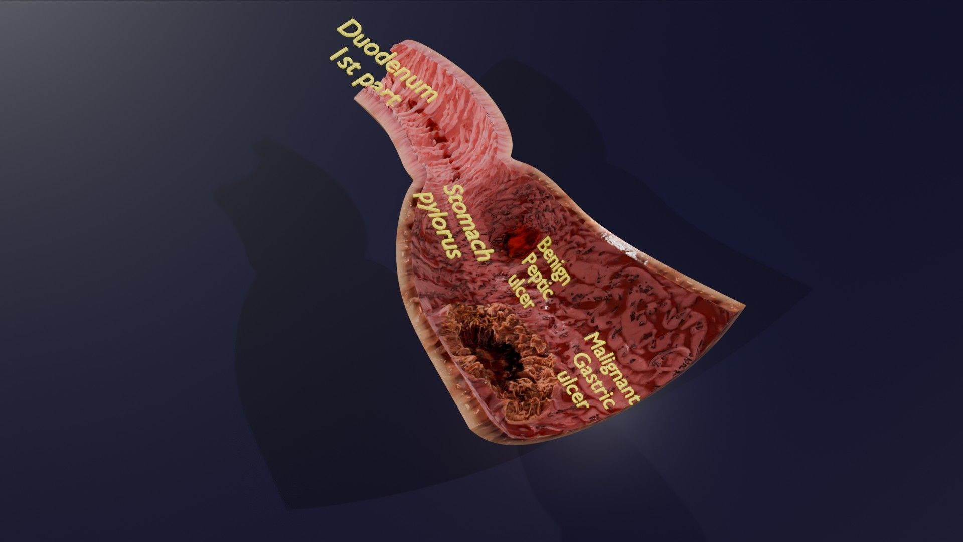 Gastric Ulcer Benign versus Malignant Low-poly 3D model_48