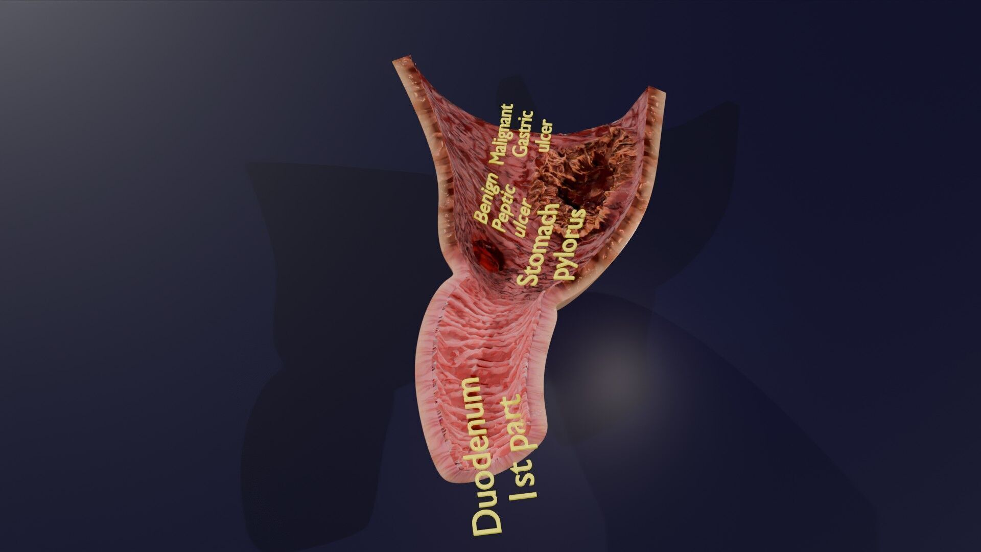 Gastric Ulcer Benign versus Malignant Low-poly 3D model_42