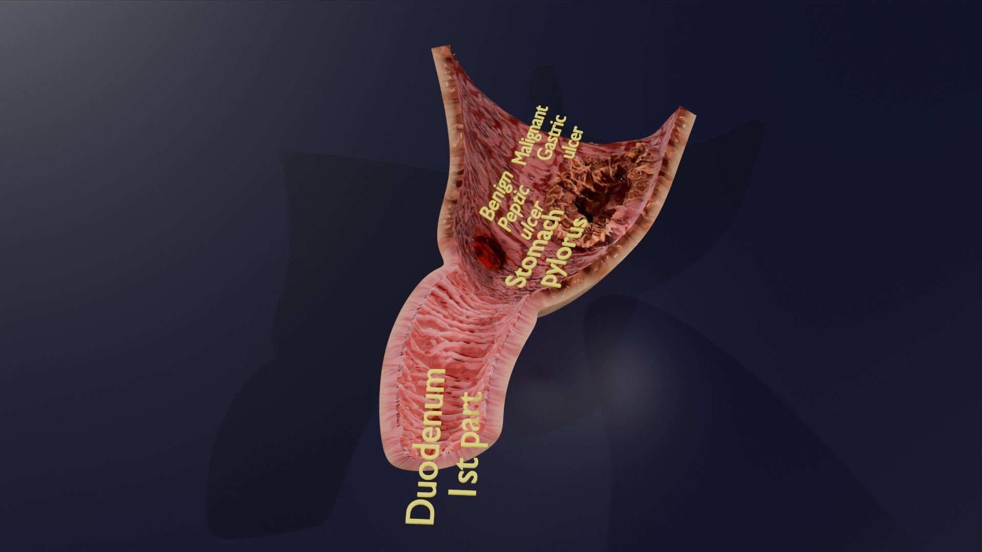 Gastric Ulcer Benign versus Malignant Low-poly 3D model_26