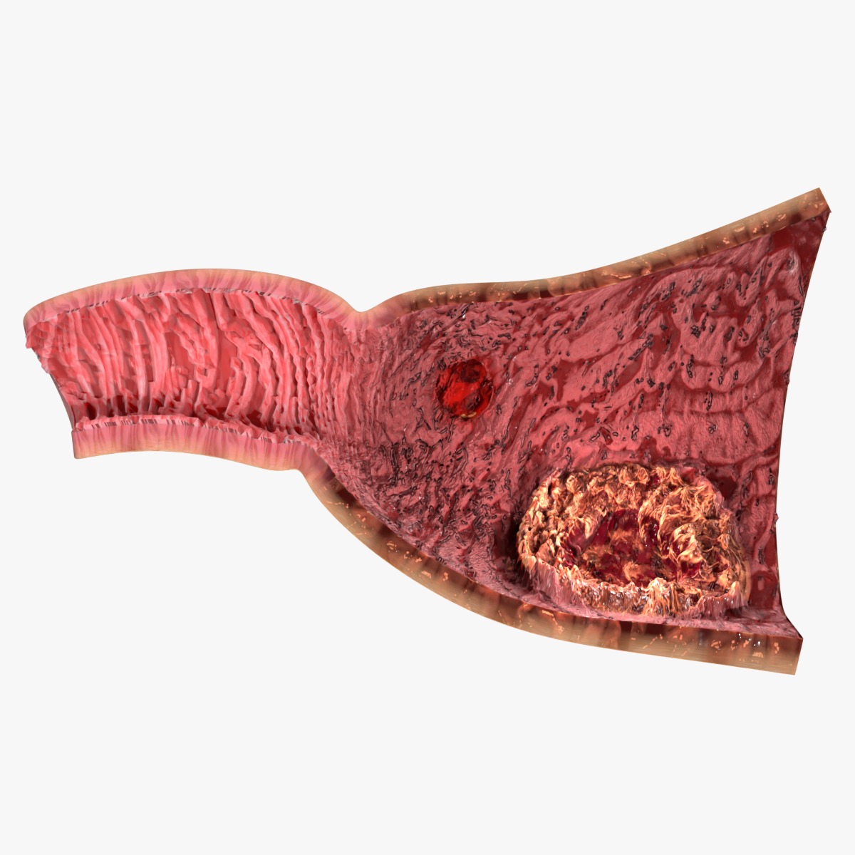 Gastric Ulcer Benign versus Malignant Low-poly 3D model_1