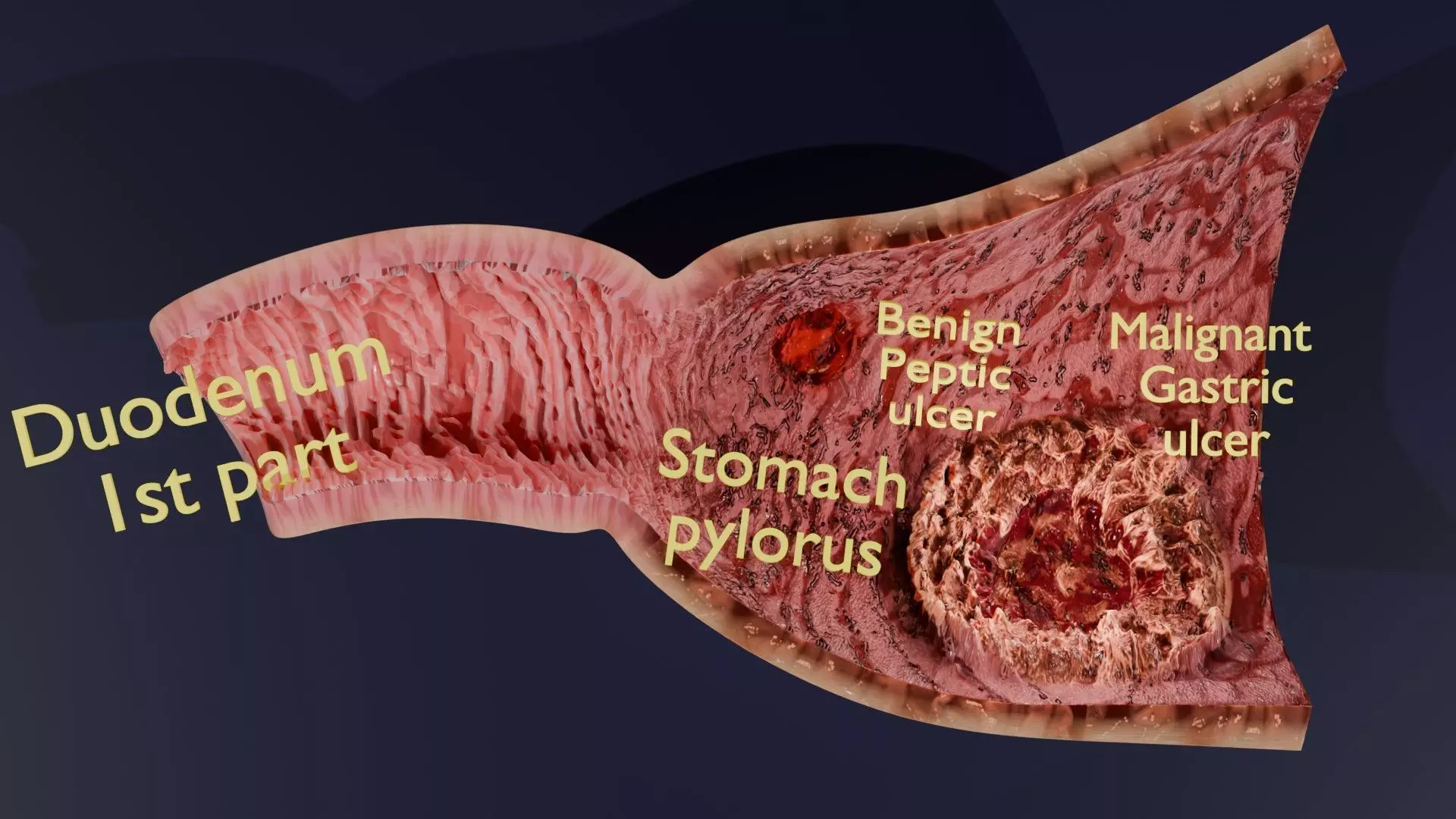 Gastric Ulcer Benign versus Malignant Low-poly 3D model_0