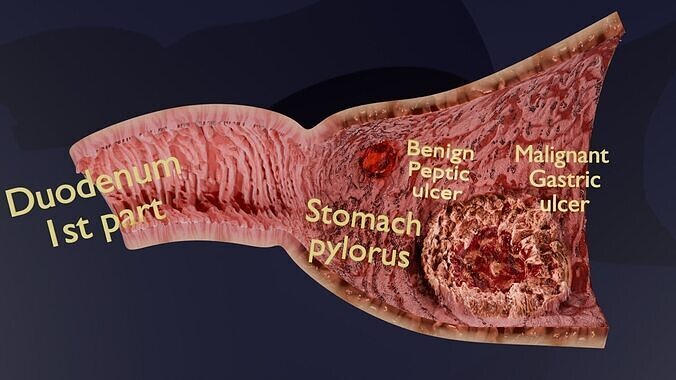 Gastric Ulcer Benign versus Malignant Low-poly 3D model