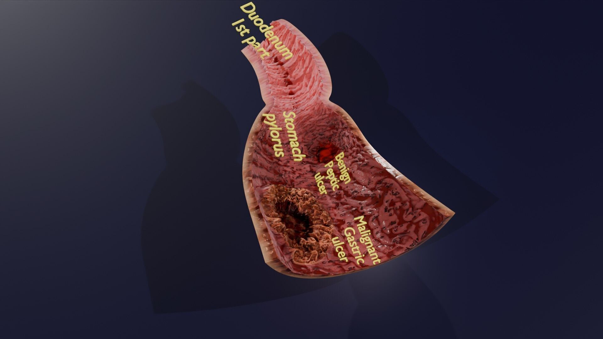 Gastric Ulcer Benign versus Malignant Low-poly 3D model_38