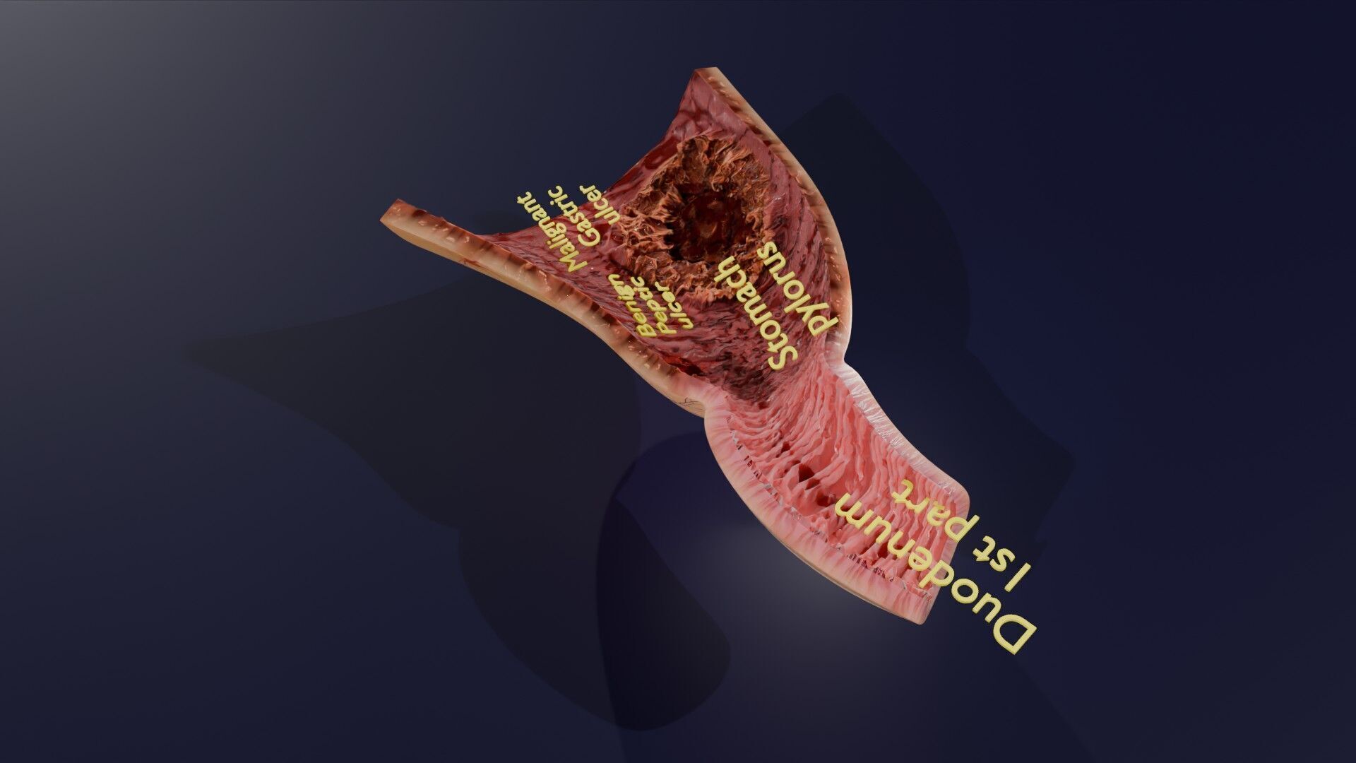 Gastric Ulcer Benign versus Malignant Low-poly 3D model_36