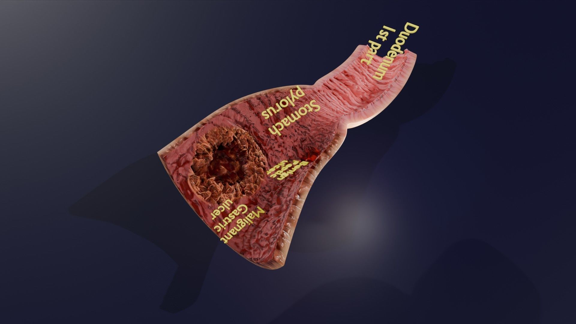 Gastric Ulcer Benign versus Malignant Low-poly 3D model_33
