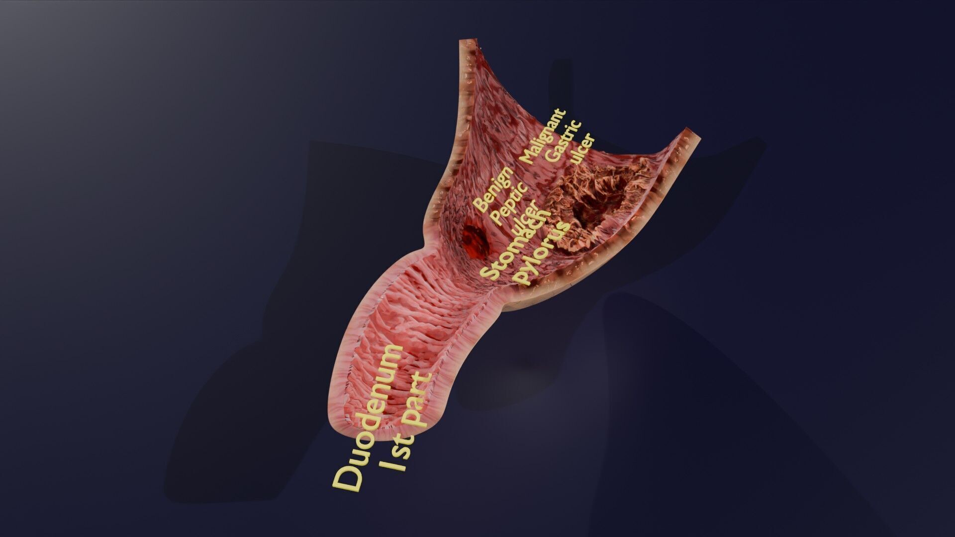 Gastric Ulcer Benign versus Malignant Low-poly 3D model_23