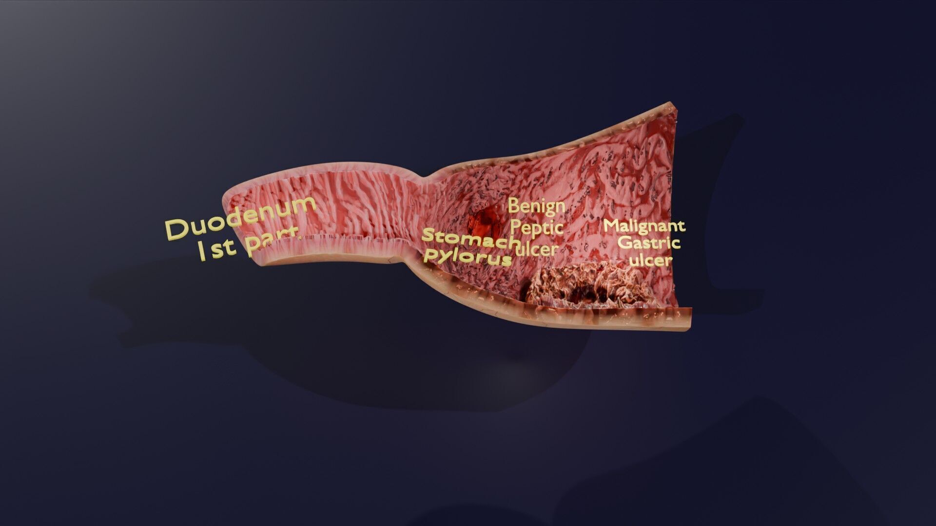 Gastric Ulcer Benign versus Malignant Low-poly 3D model_57