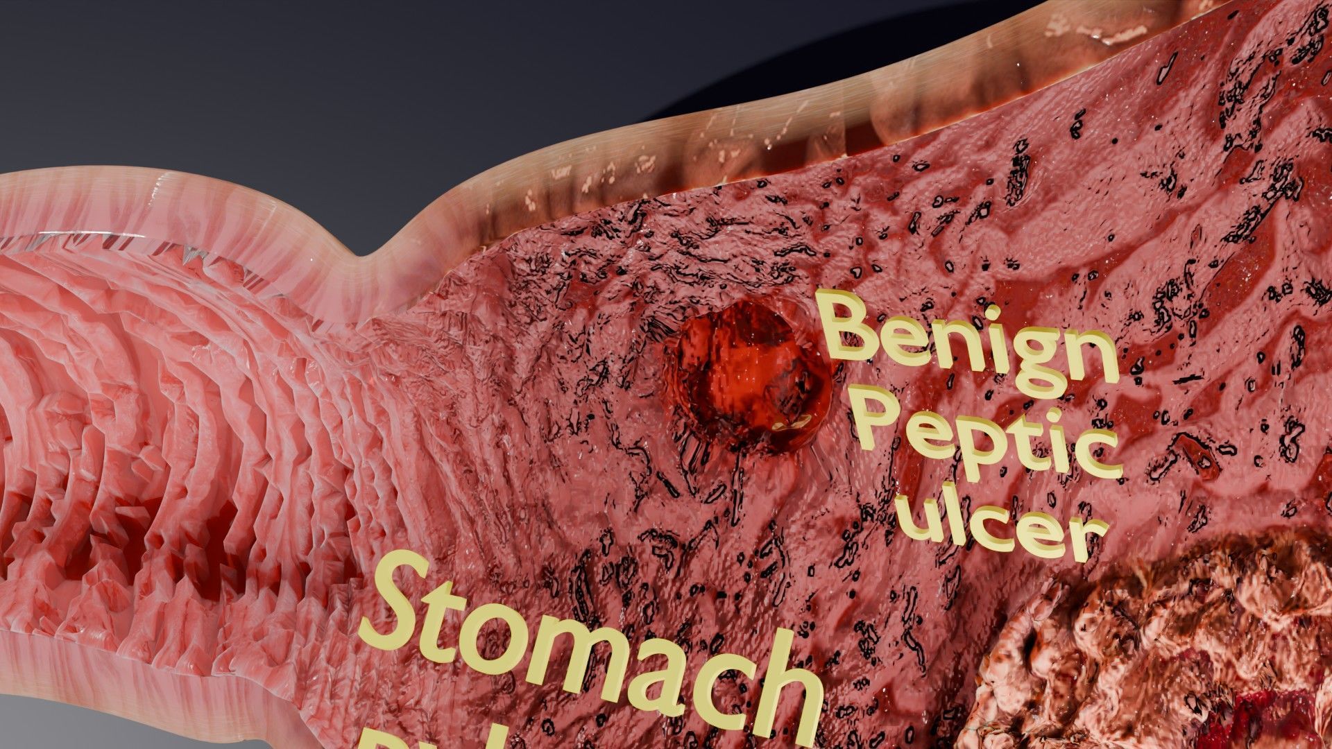 Gastric Ulcer Benign versus Malignant Low-poly 3D model_5