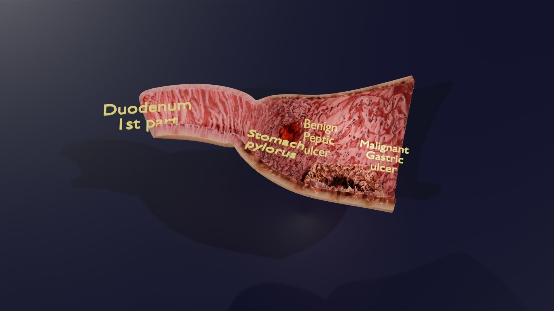 Gastric Ulcer Benign versus Malignant Low-poly 3D model_51