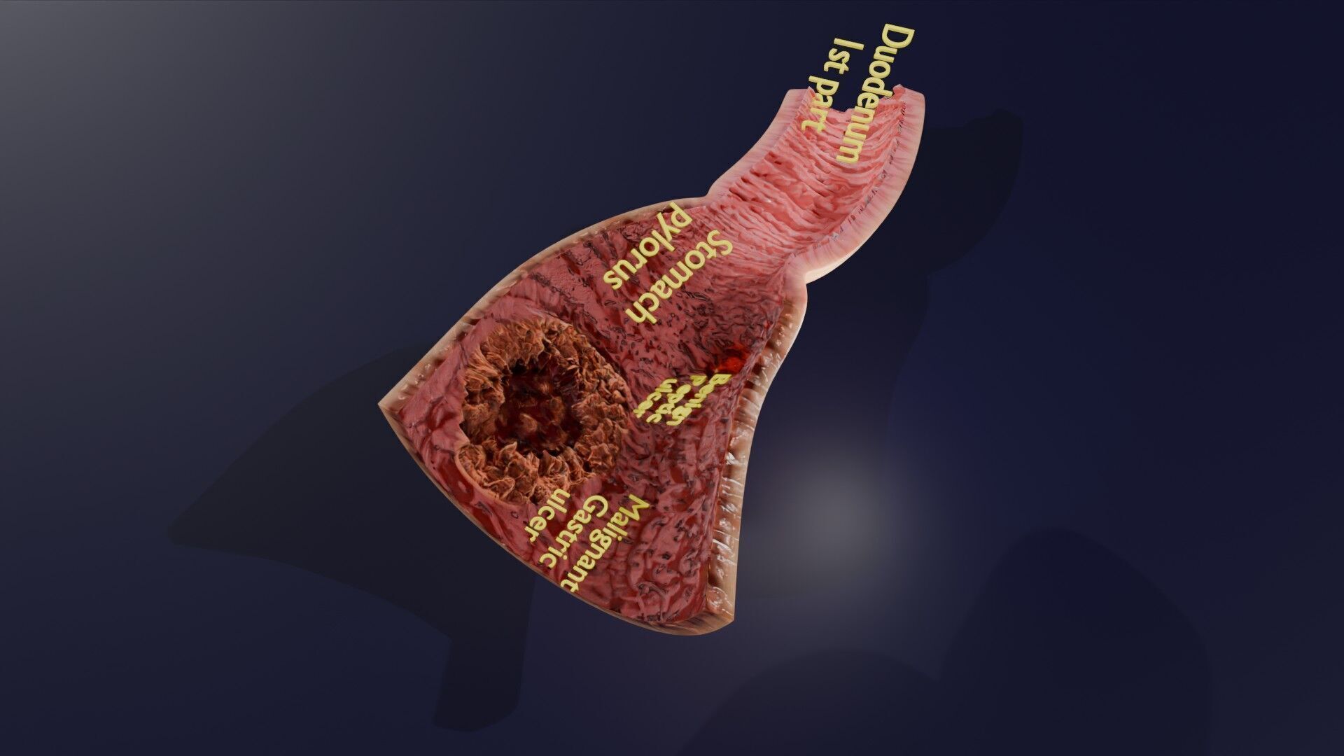 Gastric Ulcer Benign versus Malignant Low-poly 3D model_35