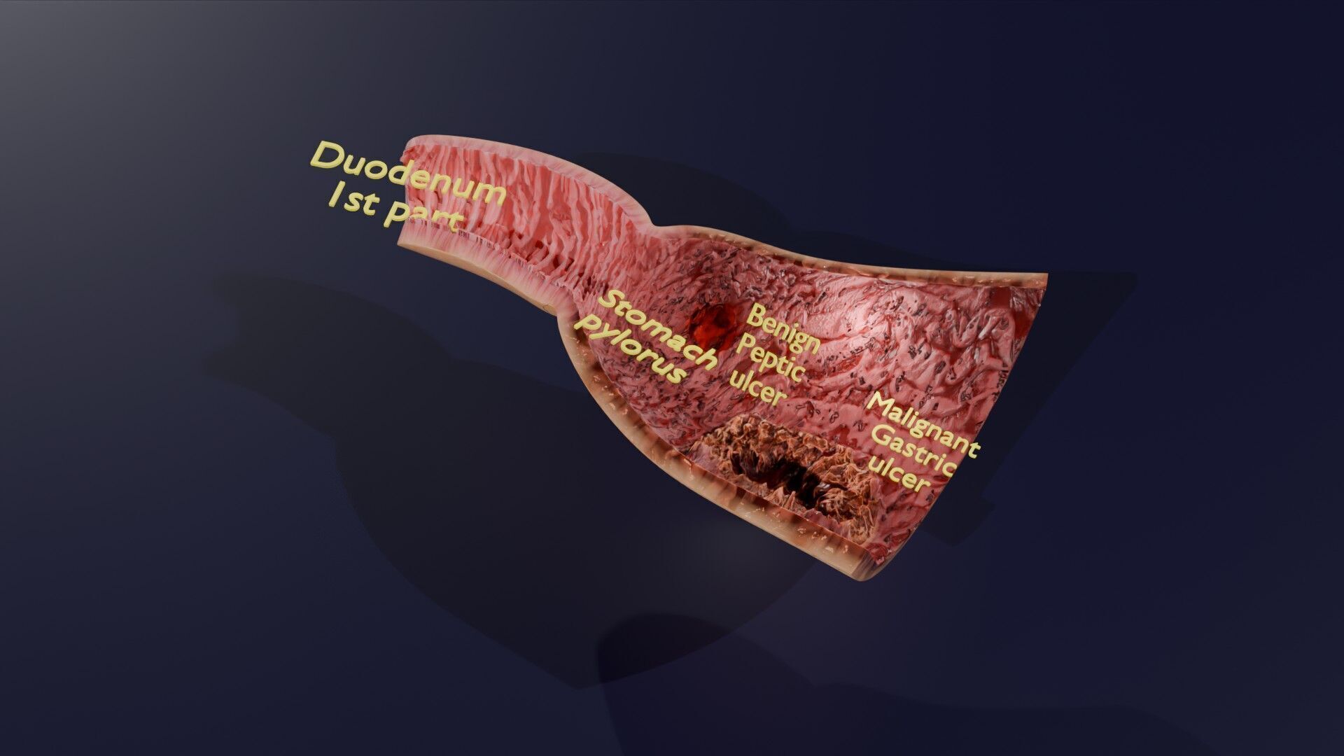 Gastric Ulcer Benign versus Malignant Low-poly 3D model_58