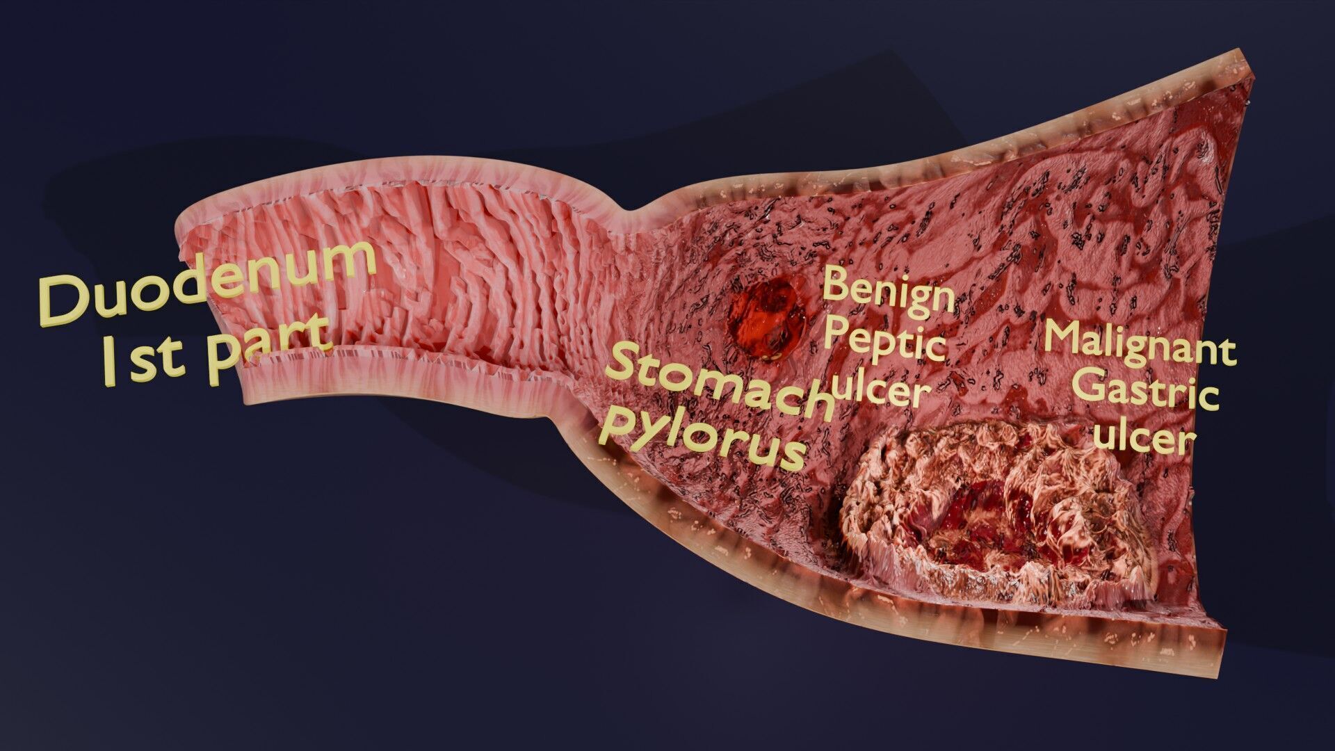 Gastric Ulcer Benign versus Malignant Low-poly 3D model_3