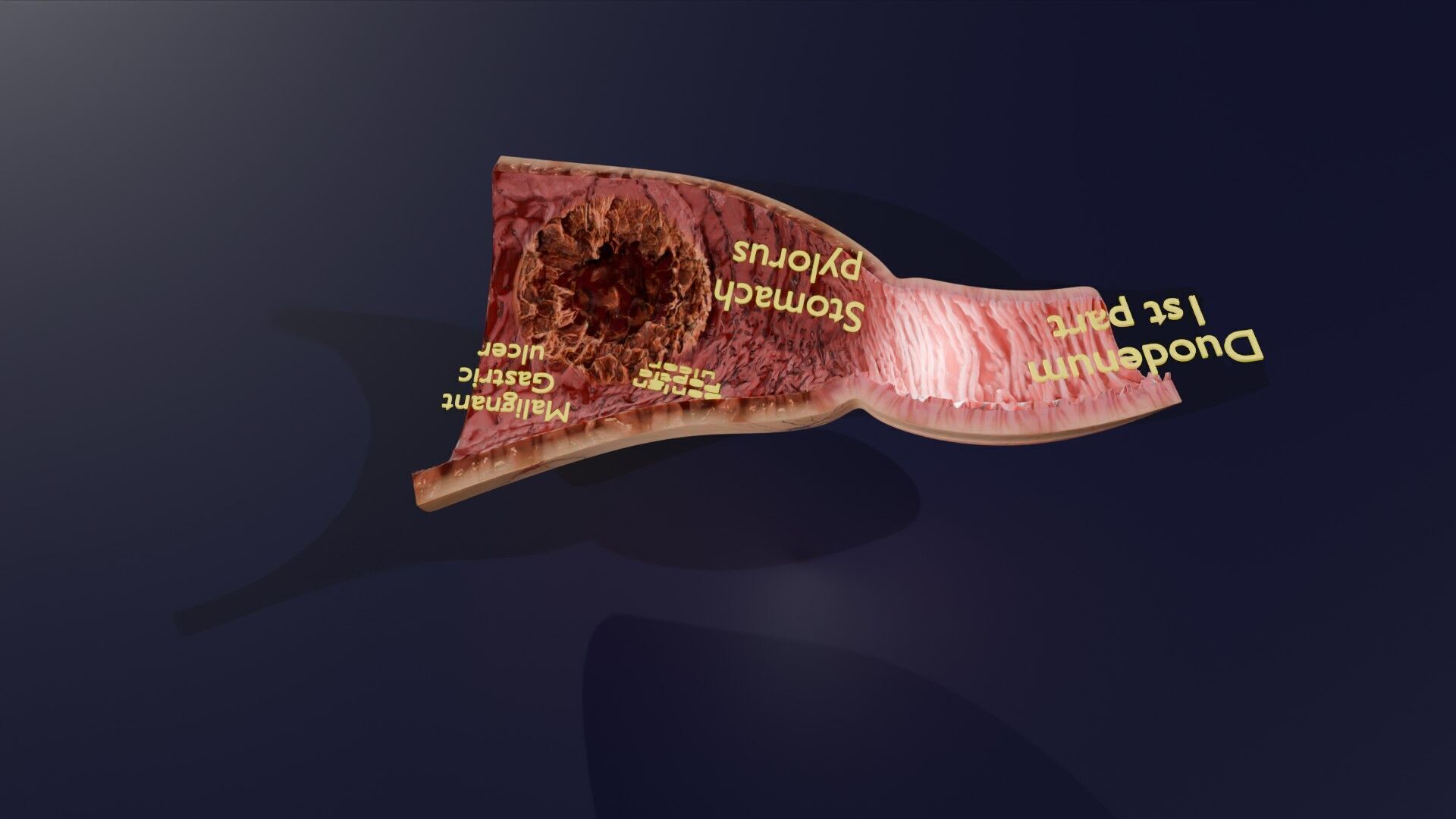 Gastric Ulcer Benign versus Malignant Low-poly 3D model_43