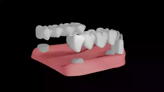 Dental Bridge Model